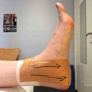 Ankle Strapping - Figure 6